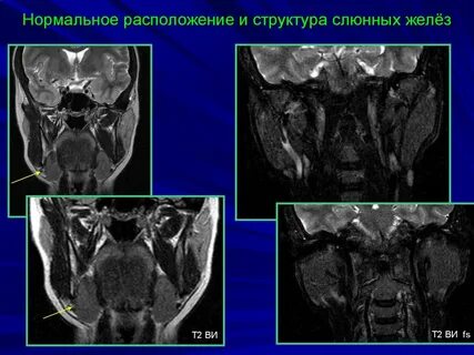 Мрт слюнных желез