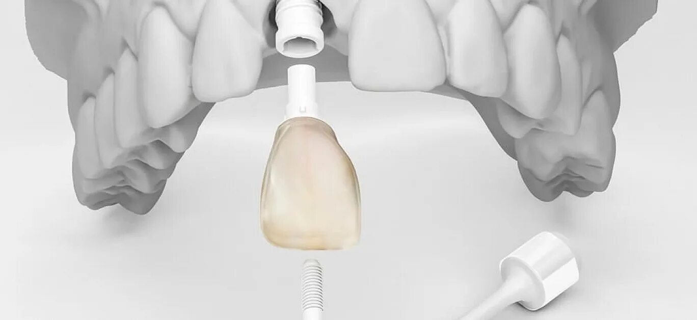 Мостовидный протез на 2 имплантах. Установка временных имплантов. Внутрикостная дентальная имплантация ортодонтического имплантата. Временный зуб на имплантате. Металлокерамическая коронка на имплантате.