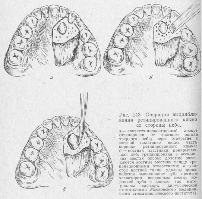 Краевая резекция пластины. Краевая резекция пластины