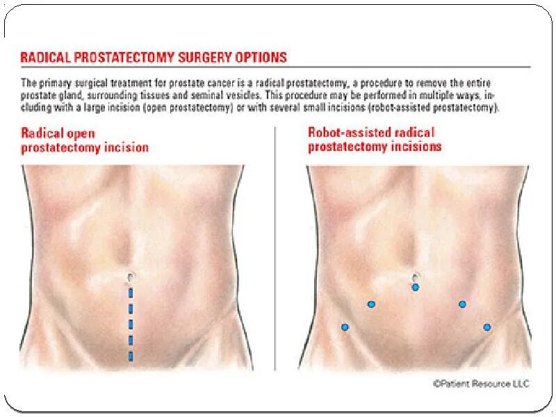 Простатэктомия простаты. Лапароскопическая радикальная простатэктомия. Радикальная простатэктомия операция. Позадилонный доступ при простатэктомии. Позадилонная аденомэктомия ход операции.