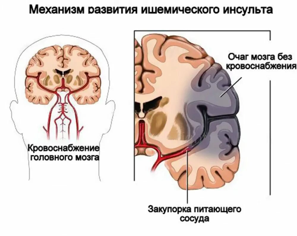 Ишемия головного мозга у пожилых людей. Ишемия головного мозга у пожилых людей