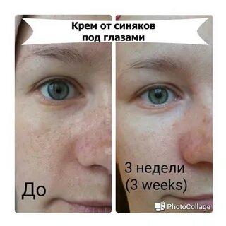 Темные круги под глазами какие витамины