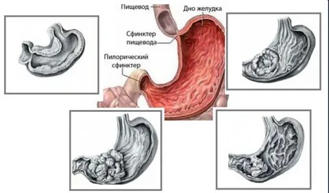 Образование в желудке