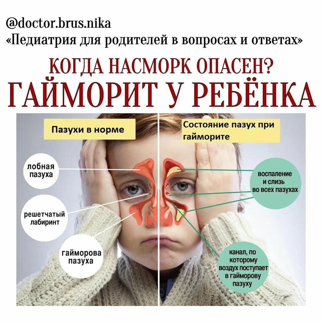 Гайморит верхнечелюстной пазухи. Воспаление носовых пазух. Гайморит фронтит этмоидит. Воспаление околоносовых пазух. Синусит фронтит гайморит разница.