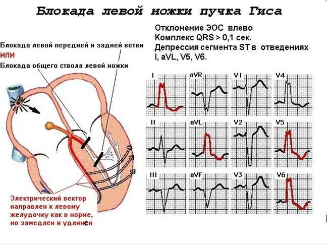 Блокада правого желудочка. Блокада левого желудочка на ЭКГ. Блокада левой ножки пучка Гиса и гипертрофия левого желудочка на ЭКГ. Гипертрофия левого желудочка с блокадой левой ножки пучка Гиса. Пучок Гиса в сердце блокада.