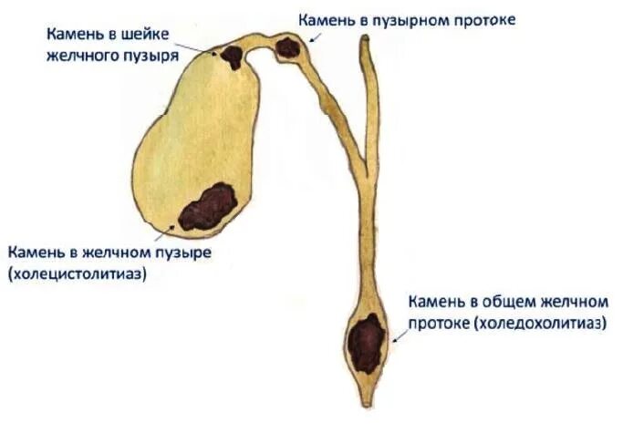 Холецистолитиаз желчного. Камень в протоке желчного пузыря. Камни в желчном пузыре схема. Конкремент в шейке желчного пузыря. Локализация желчных камней.