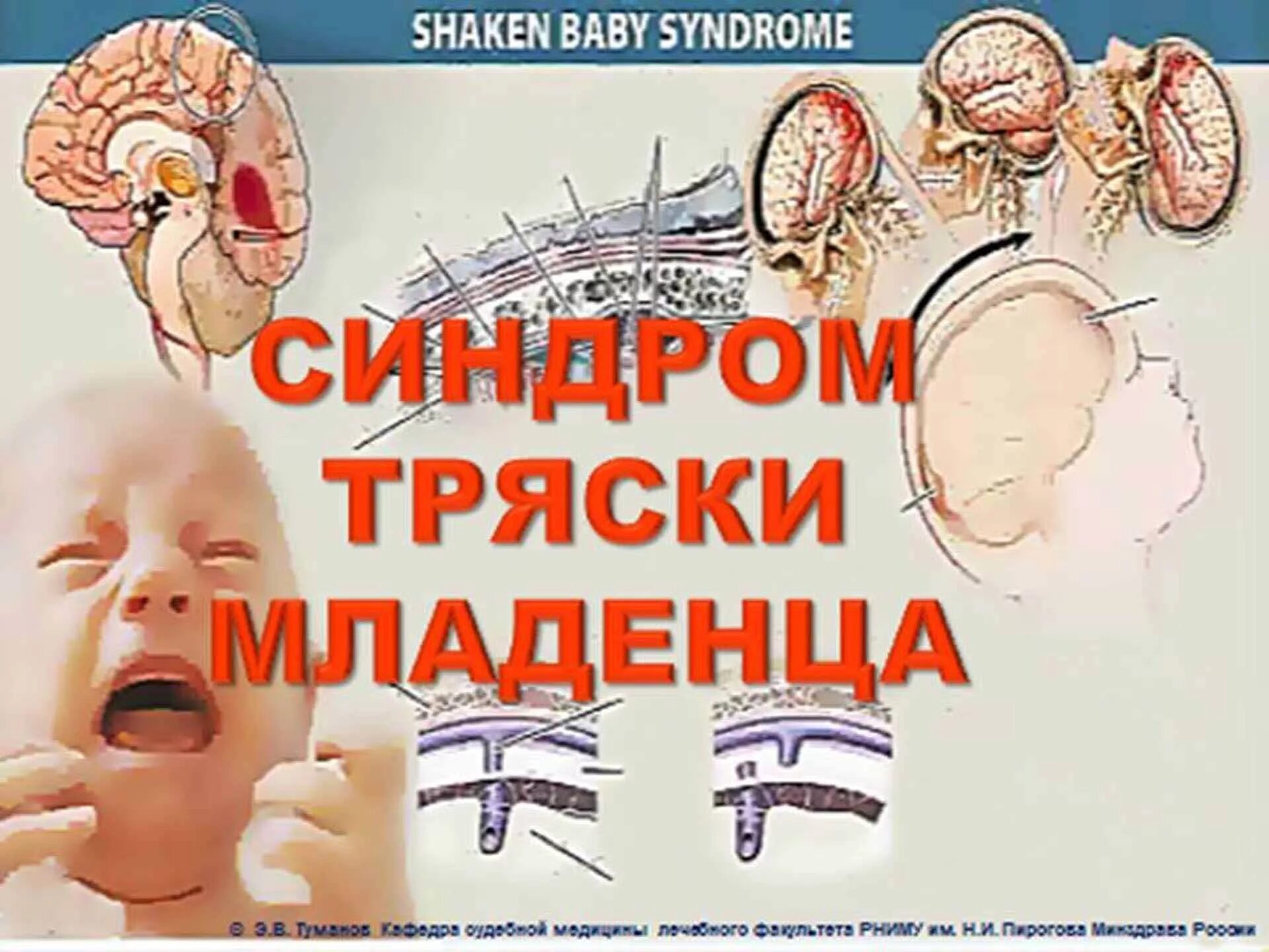 Отек мозга у новорожденных. Синдром тряски младенца. Синдром встряхнутого ребенка. Синдром встряхнутого ребенка симптомы. Синдром стряхнутой младенца.