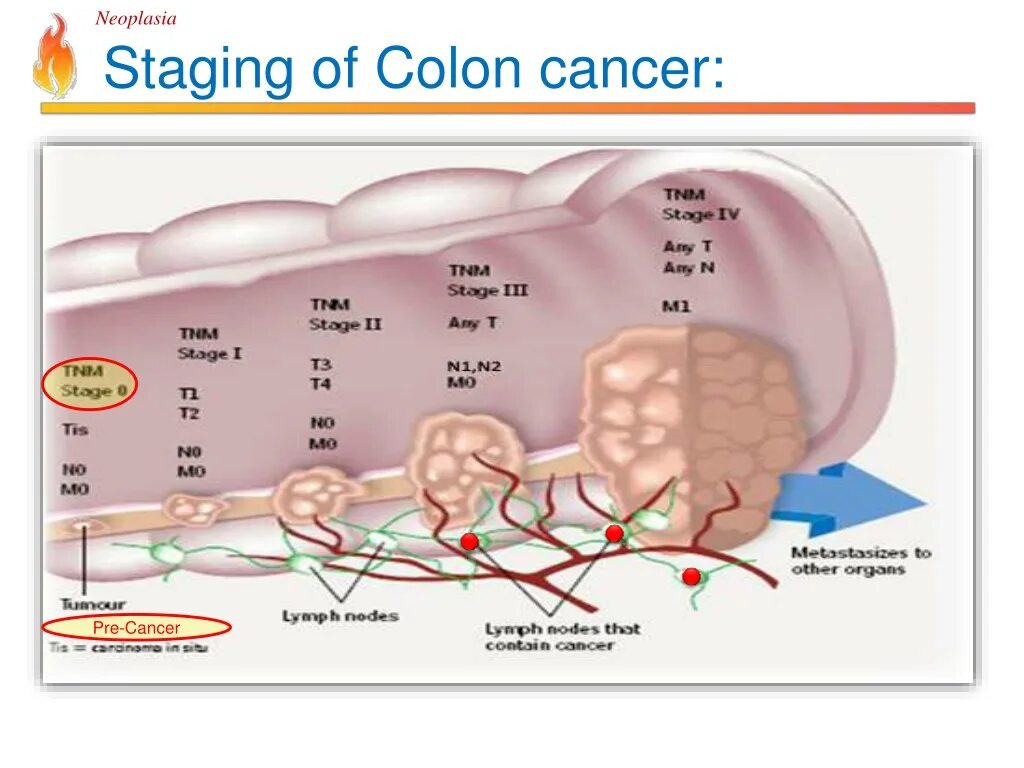 Stages of neoplasia. Stages of cancer