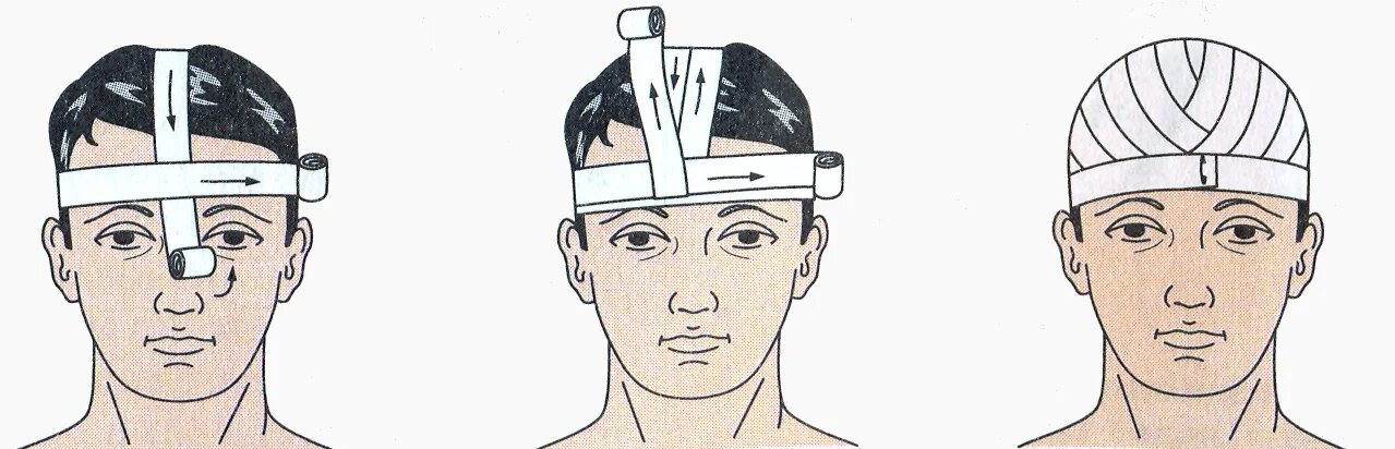 Повязка гиппократа техника наложения. Перевязка головы шапочка Гиппократа. Наложение повязки шапка Гиппократа. Шапочка Гиппократа техника. Схема наложения повязки шапка Гиппократа.