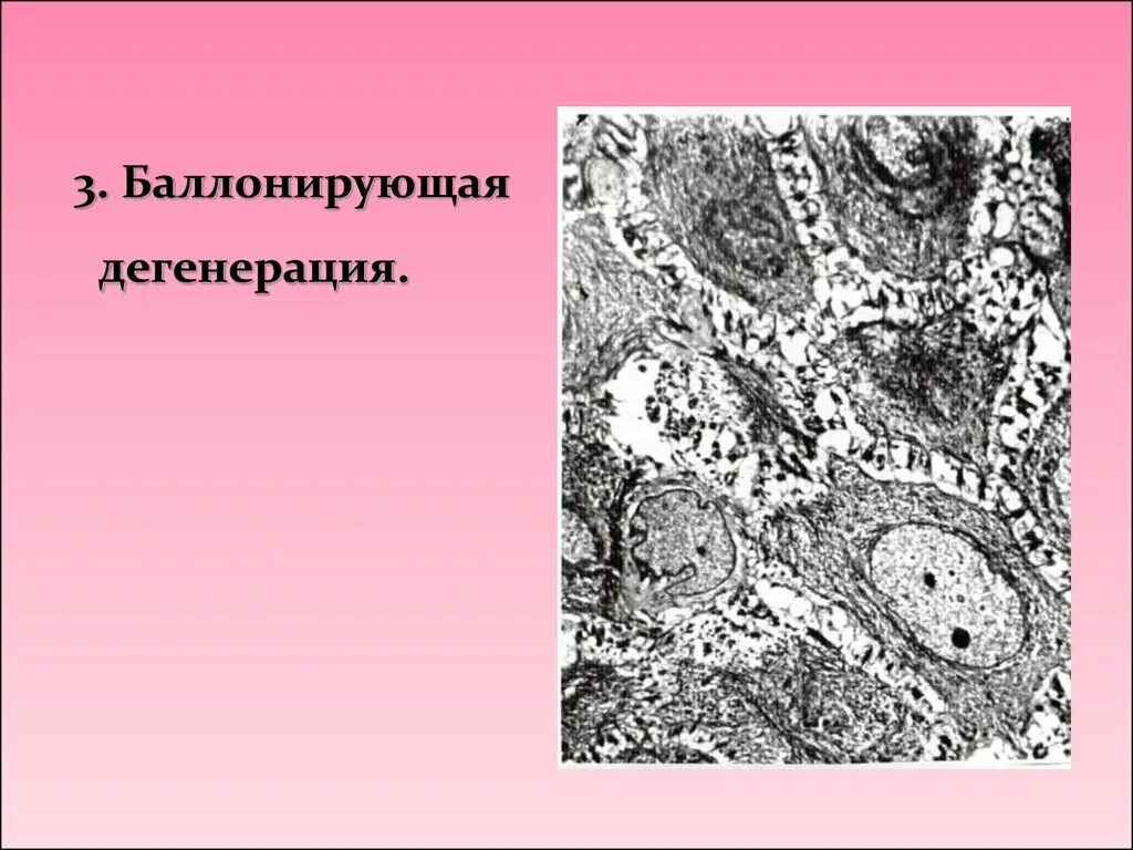 Баллонирующая дистрофия гистология. Вакуольная дегенерация (дистрофия). Балансирующая дегенерация. Баллонирующая дистрофия клеток эпидермиса.