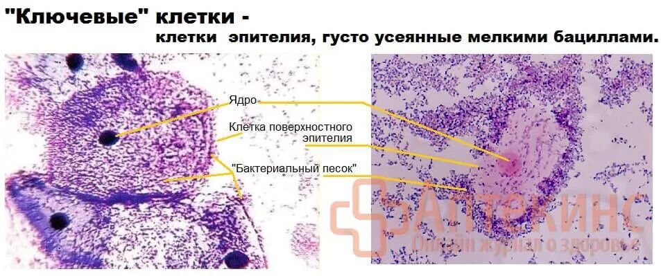 Бактериальный вагиноз микроскопия мазка. Баквагиноз ключевые клетки. Гарднерелла ключевые клетки в мазке у женщин. Ключевые клетки микроскопия.