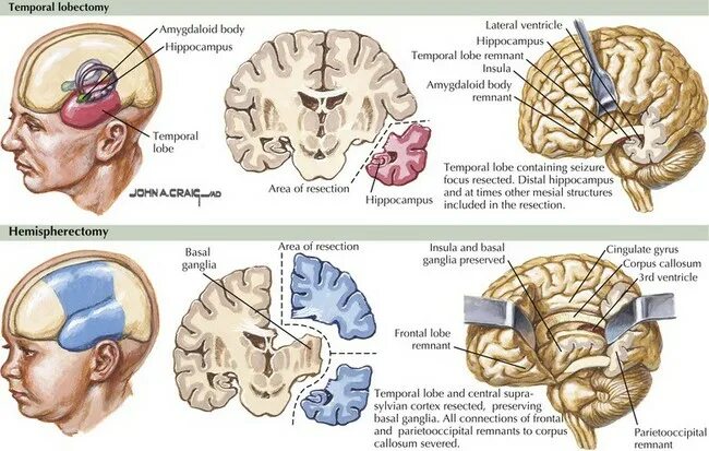 Операция при эпилепсии. Височная лобэктомия при эпилепсии. Операция при эпилепсии на головной мозг. Хирургическое лечение эпилепсии.