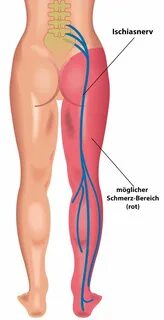 Ischiasschmerzen-Schmerzbereich