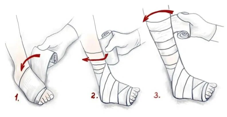 Эластичное бинтование конечности. Бинтование нижних конечностей эластичным бинтом алгоритм. Тугое бинтование голени эластичным бинтом. Схема бинтования ноги эластичным бинтом после операции. Эластичное бинтование конечностей при варикозе.