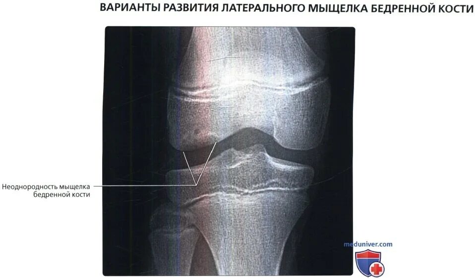 Мыщелки отек латерального мыщелка. Импрессионный перелом внутреннего мыщелка бедренной кости. Перелом мыщелка бедренной кости. Дисплазия медиального мыщелка большеберцовой кости. Остеохондральный перелом наружного мыщелка .бедренной кости.