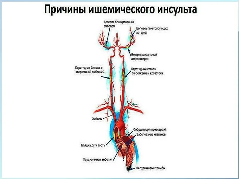 Ишемический инсульт в каротидном бассейне. Ишемический инсульт клиника. Патогенез ишемического инсульта схема. Ишемический инсульт неврология.