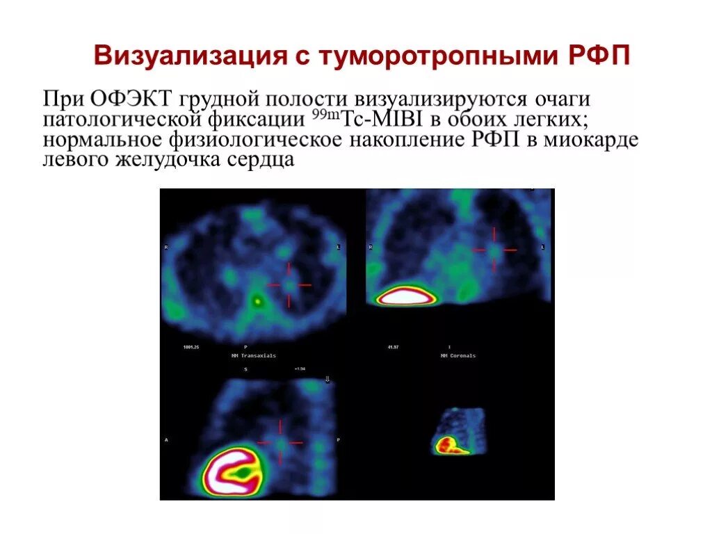 Сцинтиграфия ОФЭКТ ПЭТ. ПЭТ/кт с туморотропными РФП (18f-фтордезоксиглюкоза). Сцинтиграфия (радионуклидная диагностика). Туморотропные радиофармпрепараты. Рфп при пэт кт