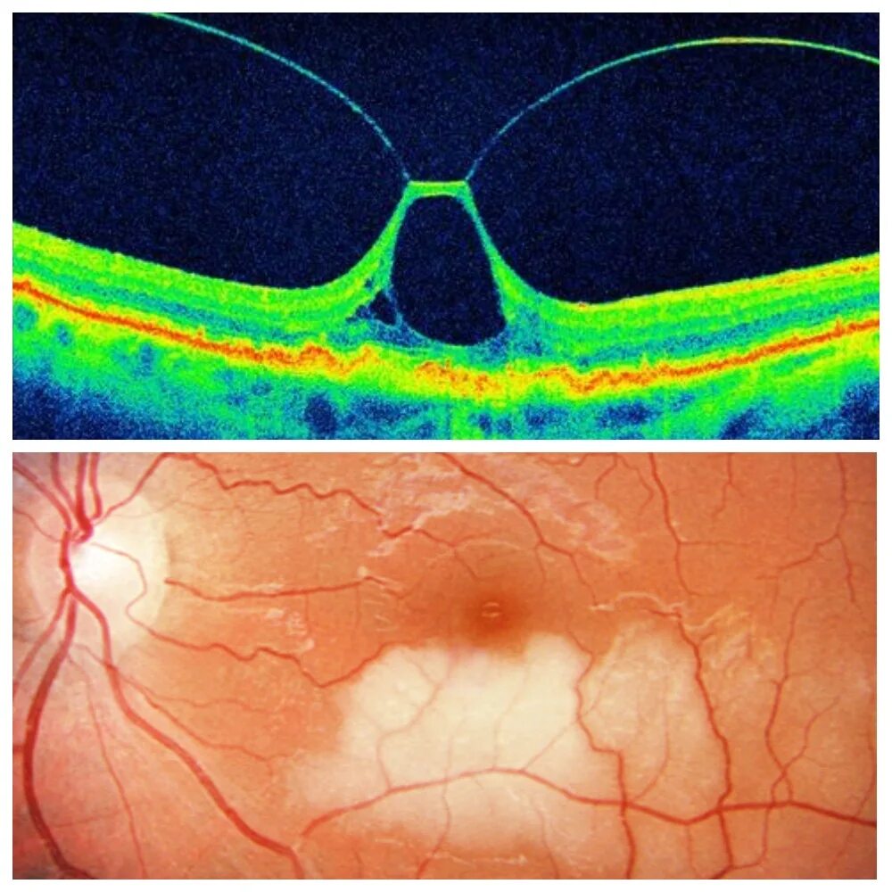Макула отслойка сетчатки. Макулярный тракционный синдром. Отслойка сетчатки макулярный разрыв. Ламеллярный макулярный разрыв. Повреждение сетчатки