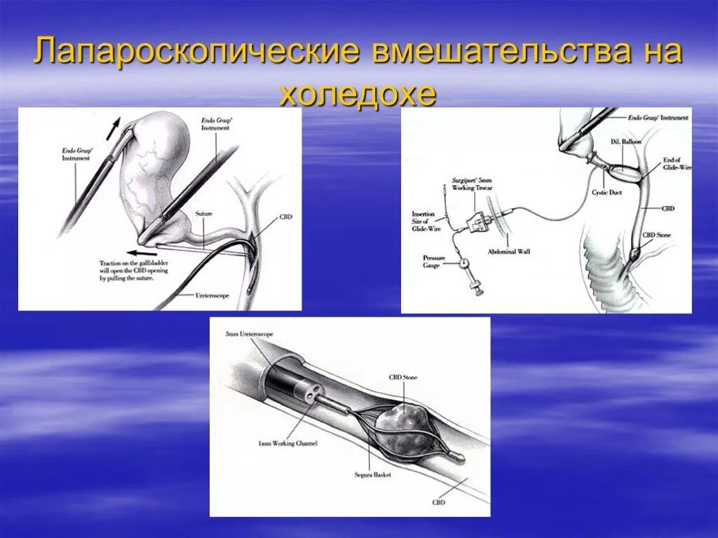 Холецистит дренаж