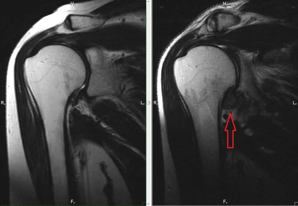 Разрыв пик. Адгезивный капсулит плечевого сустава рентген. Адгезивный капсулит плечевого сустава мрт. Капсулит плечевого сустава мрт. Капсулит плечевого сустава рентген.