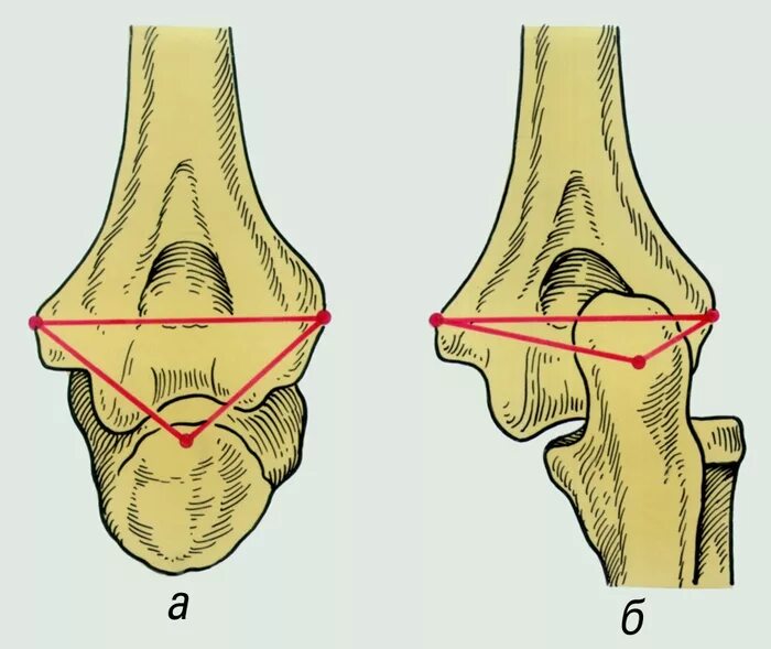Линия Маркса и треугольник Гюнтера. Линия Маркса и треугольник Гюнтера травматология. Треугольник локтевого сустава. Локтевого мыщелка
