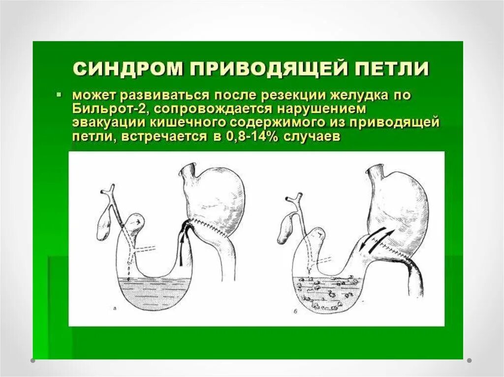 Бильрот 2 приводящая петля. Характерные признаки синдрома приводящей петли. Синдром отводящей петли после резекции желудка. Синдром приводящей петли после резекции желудка по Бильрот 2.