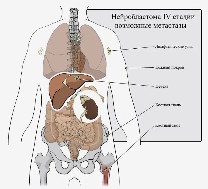 Нейробластома забрюшинного пространства 4 стадия. Нейробластома 4 стадии костного мозга. Нейробластома забрюшинная 4 степени. Нейробластома брюшной полости у детей. Метастазы в легких лимфоузлы