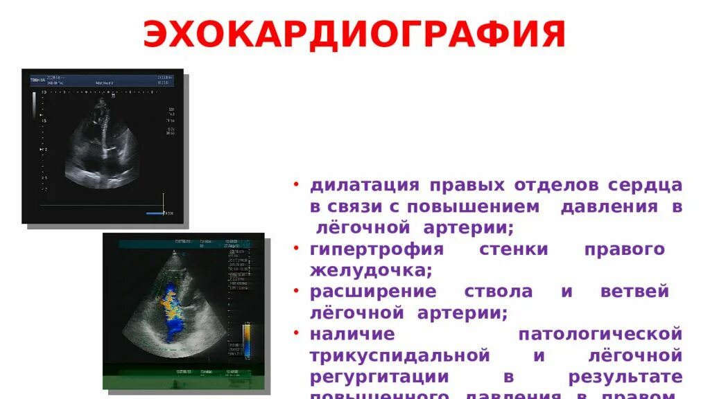 Дилатация правых отделов сердца. Дилатация полостей сердца. Дилатация камер сердца причины. Расширение правых отделов сердца. Дилатация полостей предсердий