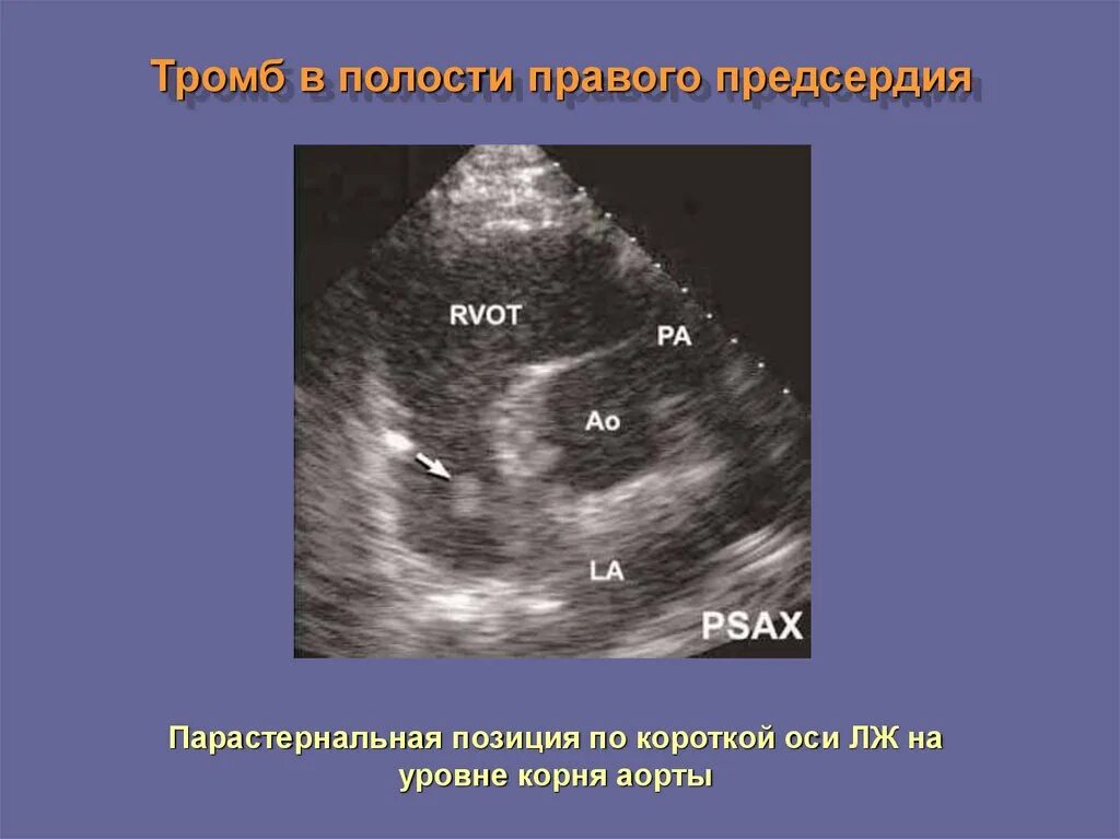 Образование левого предсердия. Тромб в правом предсердии на ЭХОКГ. Тромб в левом предсердии ЭХОКГ. Тромб в правом предсердии эхокардиография. Тромб в ушке левого предсердия кт.