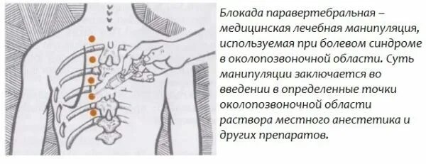 Инъекции при болях в пояснице. Паравертебральная блокада грудной отдел техника. Паравертебральная блокада пояснично-крестцовый. Паравертебральные блокады грудного отдела позвоночника. Паравертебральные блокады поясничного отдела.