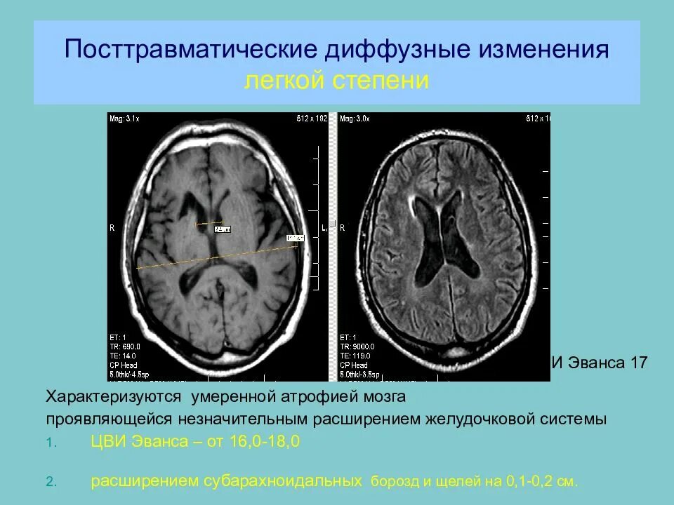 Диффузные изменения головного мозга. Атрофические изменения головного мозга кт. корковая атрофия головного мозга на кт. диффузные изменения в мозге.
