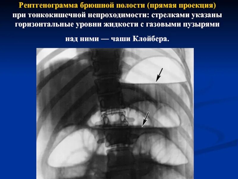 Симптом чаши. Кишечная непроходимость рентген чаши клойбера. кишечная непроходимость чаши клойбера. кишечная непроходимость рентген тонкокишечная. горизонтальные уровни жидкости рентген брюшной полости.