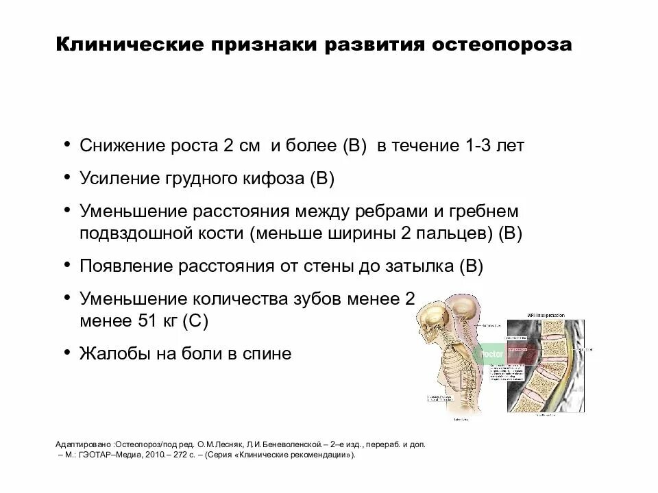 Какие анализы на остеопороз. Постменопаузальный остеопороз симптомы. Клинические признаки остеопороза. Основные клинические проявления остеопороза. Остеопороз критерии диагноза.