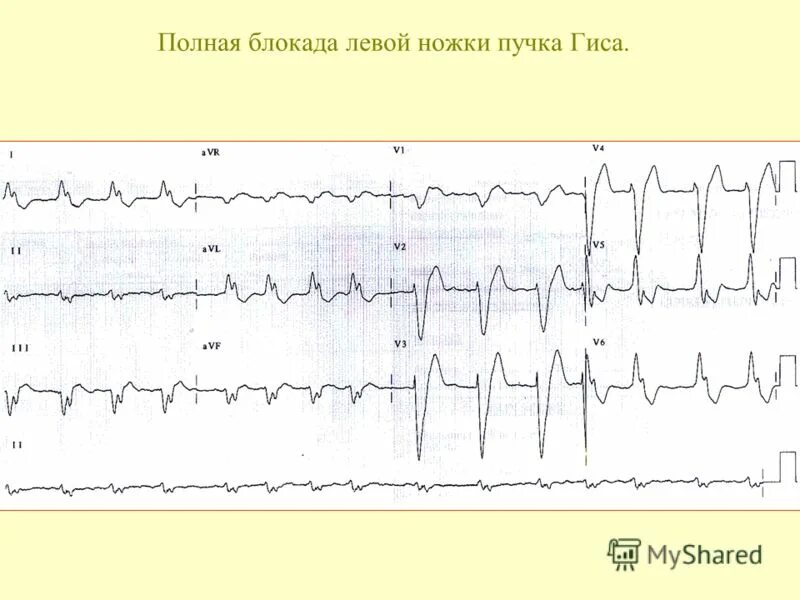 Мкб 10 блокада правой ножки пучка гиса