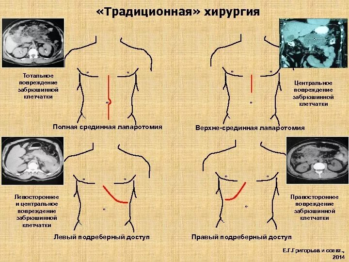 Полная срединная лапаротомия. Центральная лапаротомия. Срединно срединная лапаротомия. Средняя срединная лапаротомия.