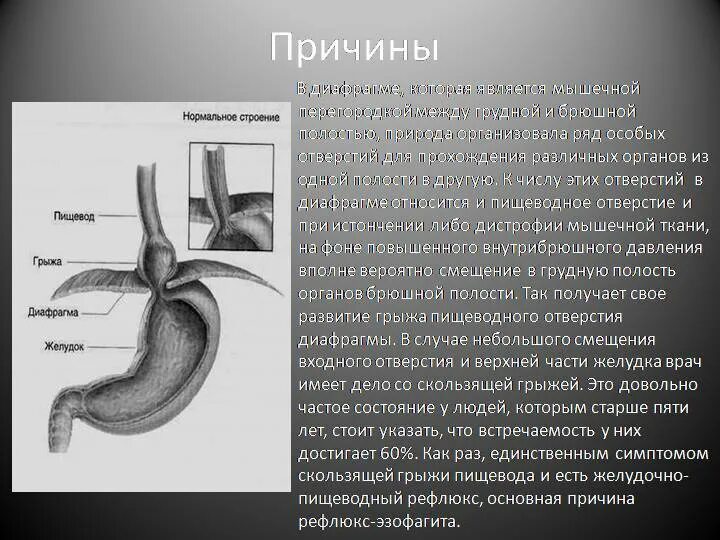 Грыжа пищеводного отверстия причины. Скользящая хиатальная грыжа. Околопищеводная грыжа. Грыжа пищеводного тракта диафрагмы. Скользящая грыжа пищеводного отверстия симптомы.