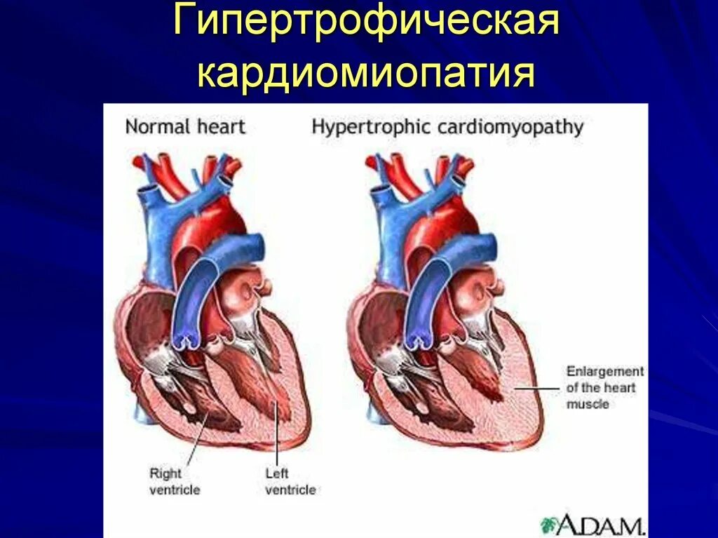 Желудочка сердца расширена. Гипертрофическая кардиомиопатия. Гипертрофической кардиомиопатии. Кардиопатия сердца у детей. Сердце спортсмена и обычного человека.