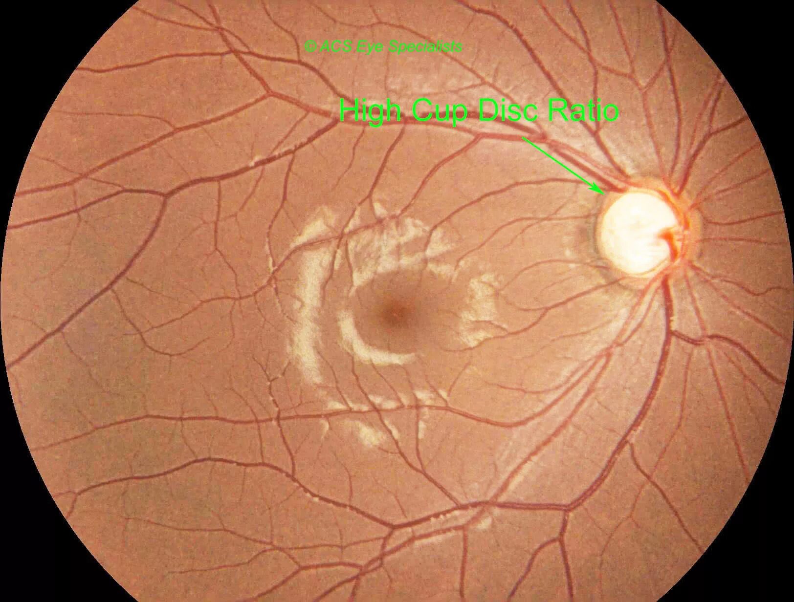 Флебогипертензивная глаукома. Гиперсекреторная глаукома.