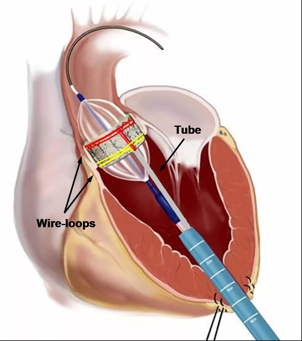 Как клапан делает операция. Транскатетерная имплантация аортального клапана. Тави аортального клапана. Транскатетерная имплантация клапана. Транскатетерная имплантация аортального клапана Tavi.