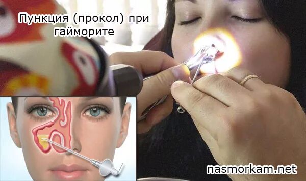 Прокол носа при гайморите видео. Гнойный гайморит прокол. прокол носа при синусите.