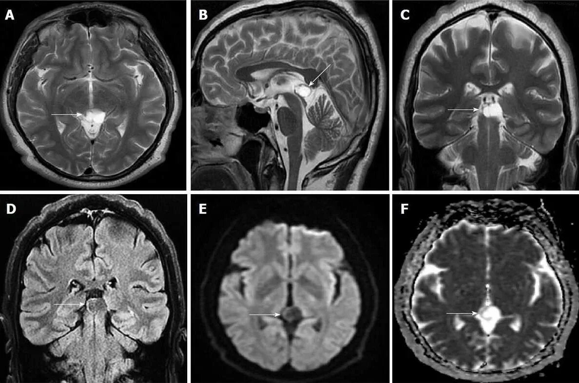 Кисты головного мозга на кт. Кисты головного мозга на кт. Киста левой лобной доли. Арахноидальная киста головного мозга на кт. Киста в 3 желудочке мозга.