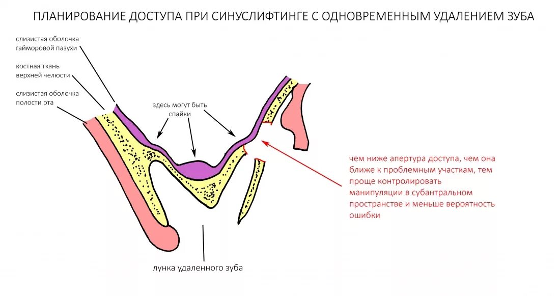Можно ли электронную сигарету после удаления зуба. Осложнения синус лифтинга. рекомендации после синус лифтинга открытого. открытый синус лифтинг зуба. после синус лифтинга осложнения открытого.