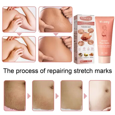 Crème anti-Vergetures
