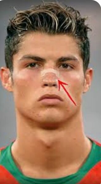 Nasal strip