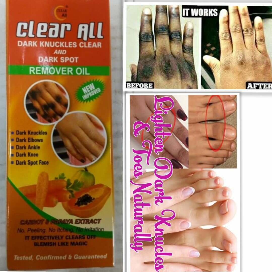 Dark spot removal
