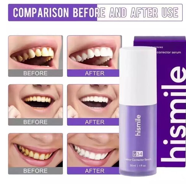 Teeth Whitening