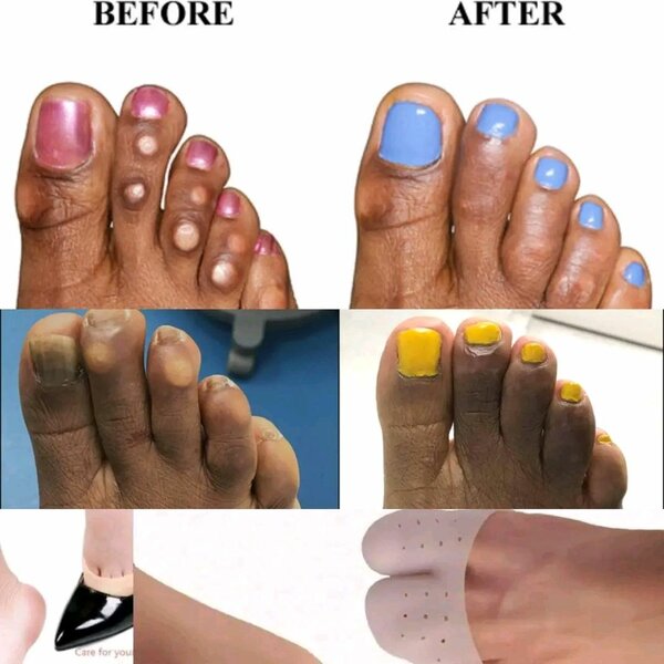 GEL TOE CAPS