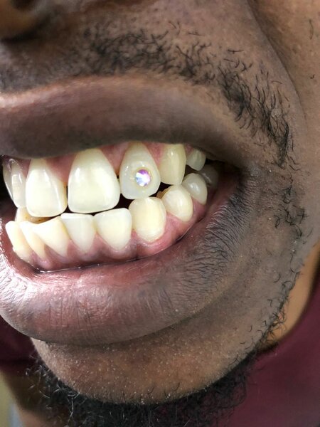 Tooth gems