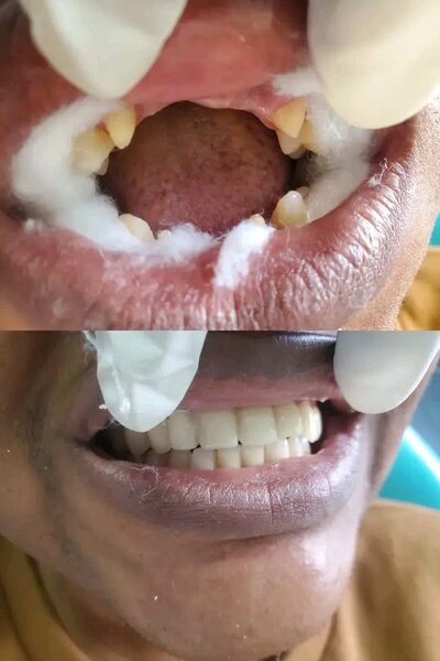 Zirconia crown