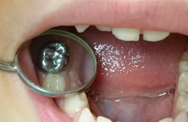 Silver tooth crown